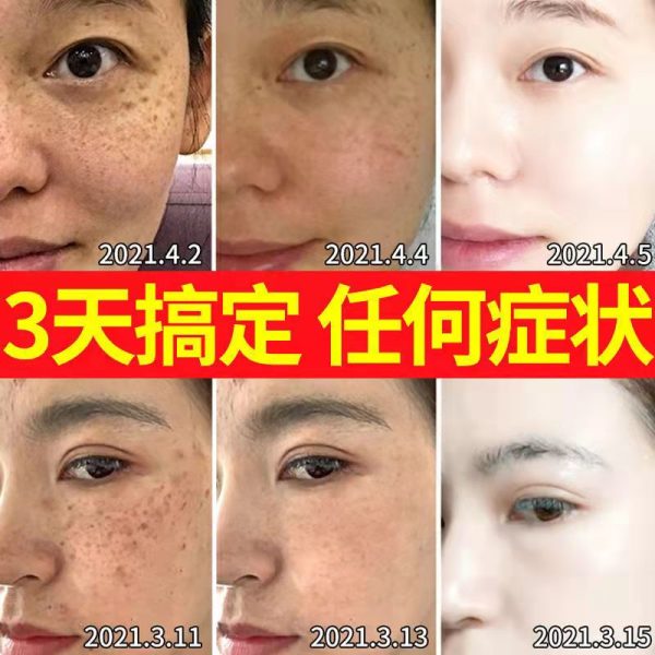 Genuine whitening and freckle removing cream - Image 2