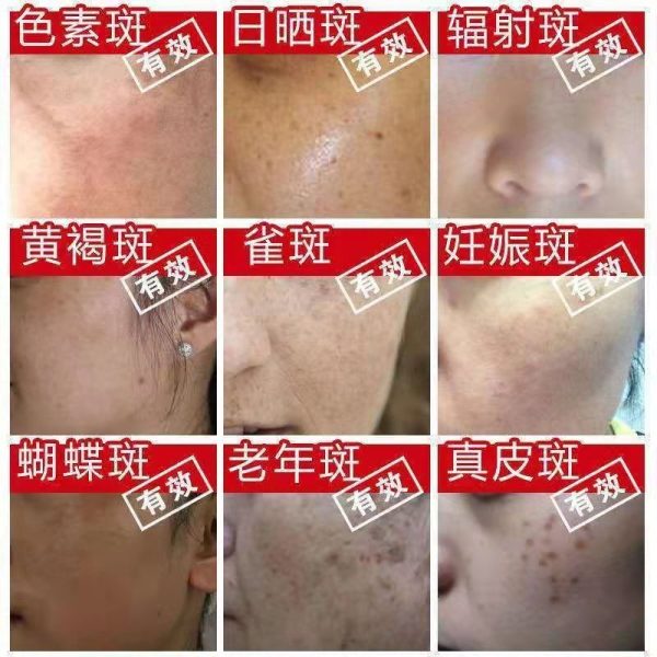 Genuine whitening and freckle removing cream - Image 4